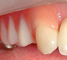 水野歯科クリニック　入れ歯　ノンクラスプ02
